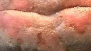 Lucas Viatri, delantero del Peñarol de Uruguay, sufrió quemaduras de tercer grado