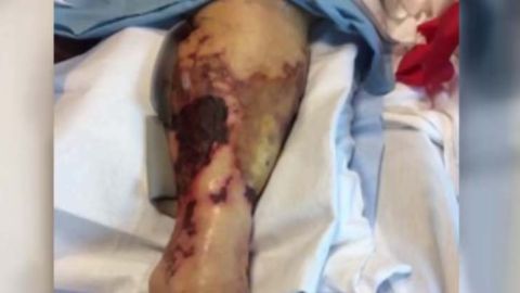 La mayoría de los casos de la infección en Estados Unidos ocurren entre mayo y octubre.