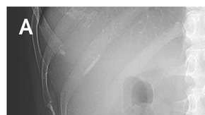 Una mujer muestra hinchazón por tres años y el motivo son dos gasas que quedaron en su interior.