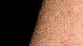 Luego del tercer o cuarto día de la infección, la persona desarrolla una erupción en casi todo el cuerpo.