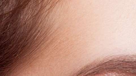 Las arañas vaculares en el rostro son más comunes en las mujeres y aparecen con mayor frecuencia en las mejillas y alrededor de la aletas de la nariz.