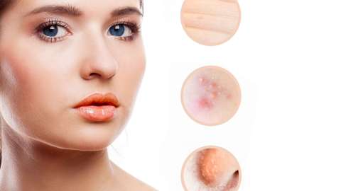 Las arañas vaculares en el rostro son más comunes en las mujeres y aparecen con mayor frecuencia en las mejillas y alrededor de la aletas de la nariz.