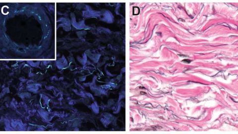 Las partes en azul oscuro son haces de colágeno fibrilar. En la imagen de la derecha se ven las fibras de elastina en negro y las estructuras de colágeno en rosa.