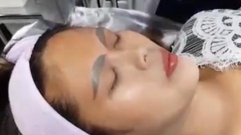 A la joven se le realizó un tratamiento correctivo con laser.