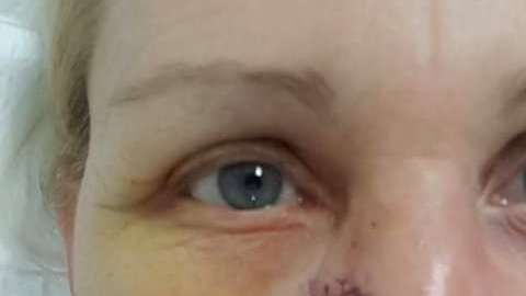 Narelle Krikhoff, de 53 años, descubrió que tenía cáncer y que no era una marcad e los lentes.