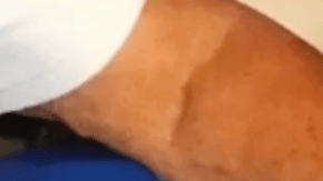 Jaimeson y Anderson tienen una enfermedad que les ha transformado la cara y ambos sufrieron acoso escolar de pequeños.