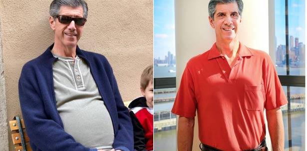 Kevin Daly, antes y después de la cirugía.