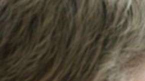 El síntoma más común del melanoma es la aparición de un nuevo lunar o la presencia de cambios en uno ya existente.