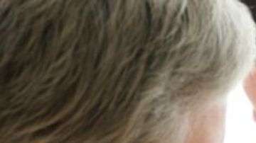 El síntoma más común del melanoma es la aparición de un nuevo lunar o la presencia de cambios en uno ya existente.