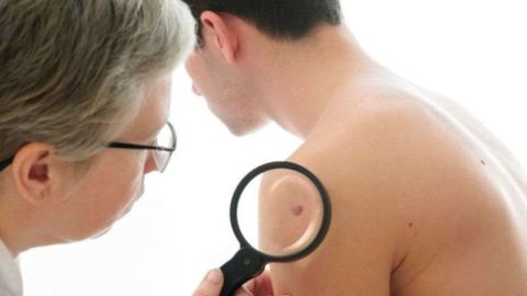 El síntoma más común del melanoma es la aparición de un nuevo lunar o la presencia de cambios en uno ya existente.
