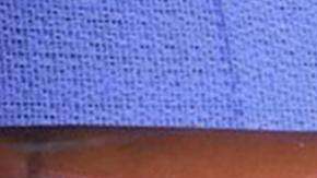 La primera cirugía de transplante con proceso de regeneración interna realizada por el cuerpo médico militar.