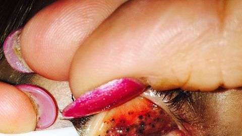 Esta mujer descubrió las consecuencias de no desmaquillarse apropiadamente.