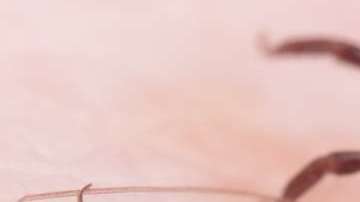 Descubre cuáles son su síntomas y cómo puedes prevenir dicha enfermedad.