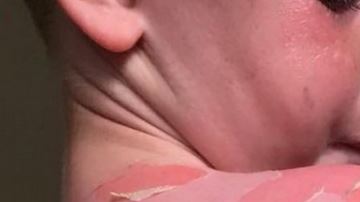 Oscar Martin sufrió quemaduras de primer grado