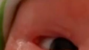 Bebé con la enfermedad congénita ictiosis del Arlequín.