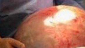 Una mujer tenía un quiste de 50 libras en su ovario.