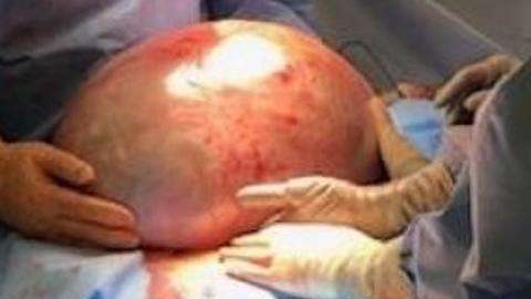 Una mujer tenía un quiste de 50 libras en su ovario.