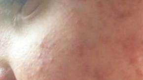 El acné quístico de un adolecente con autismo.