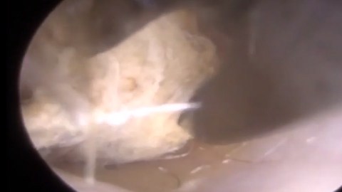 En el video, se ve claramente los vellos y cartílagos.