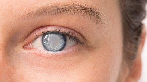 glaucoma