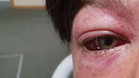 Los médicos compararon las lesiones de Tyler con las sufridas por los pilotos de combate cuando no están usando una máscara de oxígeno.