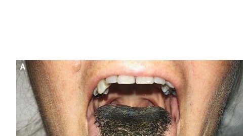 lengua negra