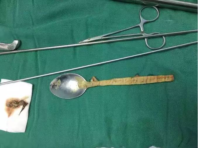 El hospital mostró la cuchara que le extrajeron al paciente.