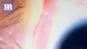 Al bebé le extrajeron más de 11 gusanos.