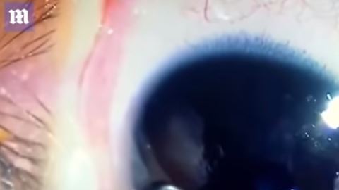 Al bebé le extrajeron más de 11 gusanos.