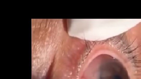 parasito ojo