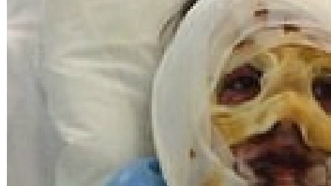 La paciente sufrió quemaduras en el 90 % de su cuerpo.