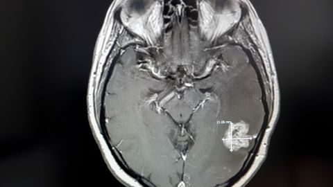 tumor cerebral