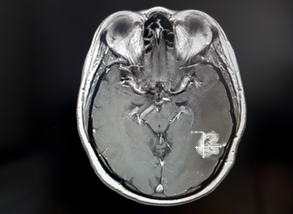 Así se ve un tumor cerebral en una resonancia magnética.