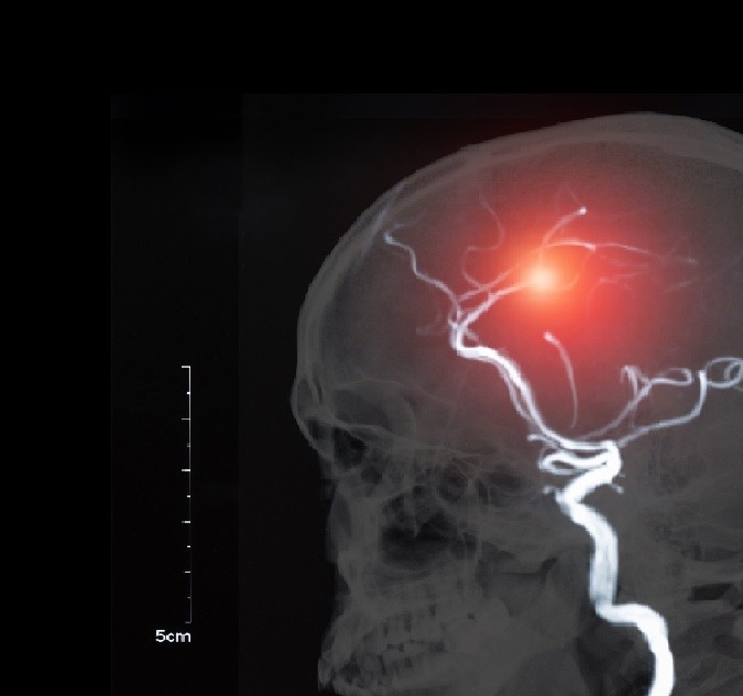Síntomas de stroke: cómo reconocer un ACV