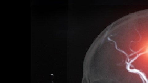 stroke