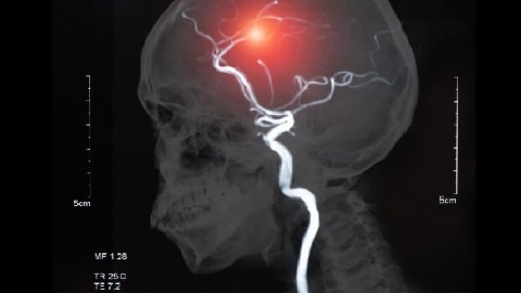 stroke