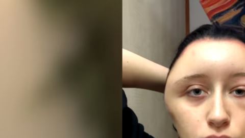 A las pocas horas de haberse aplicado el tinte, así quedó su cabeza.