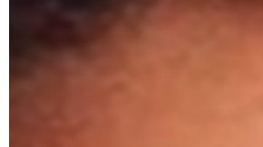 La joven contrajo una infección por querer agrandarse los labios.