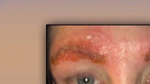 En tres días, sus cejas comenzaron a infectarse.
