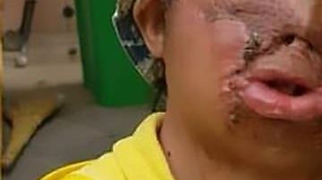 Bakhtiyer Sindrov sufrió quemaduras siendo un bebé.