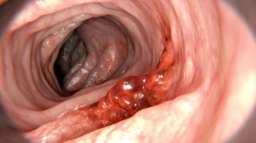 Untreated colorectal polyps can develop into colorectal cancer