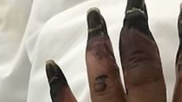 El dilema para la mujer comenzó cuando se desantendió una herida en la mano.