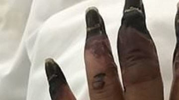 El dilema para la mujer comenzó cuando se desantendió una herida en la mano.