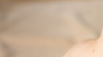 Niño afectado por sarampión