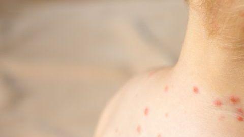 Niño afectado por sarampión