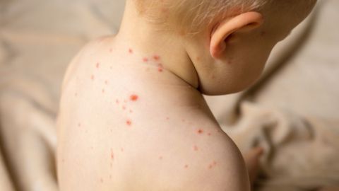 Niño afectado por sarampión