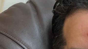 Jorge Viera con el rostro desfigurado por la infección.