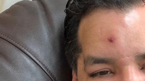 Jorge Viera con el rostro desfigurado por la infección.