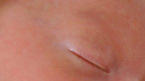 Los gemelos idénticos son invariablemente del mismo sexo, pero un caso en Australia fue la excepción.