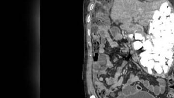 El asiático tuvo que ser intervenido qirúrgicamente.